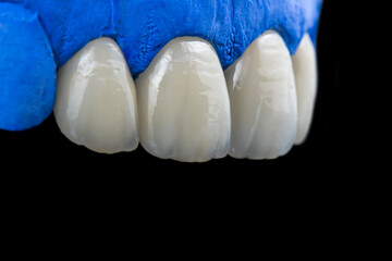 emax crowns and veneers