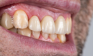 emax crowns and veneers