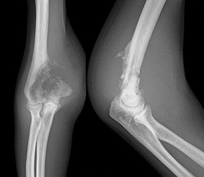 osteosarcoma  xray  elbow bone tumor 
