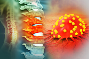 Spine cancer or spinal tumor disease. 3d illustration - obrazy, fototapety, plakaty