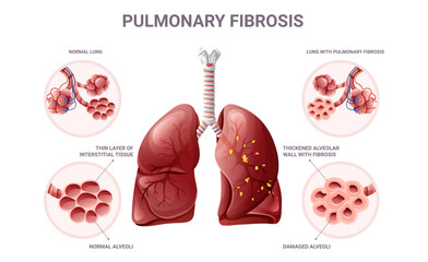 Pulmonary fibrosis and normal lung tissue infographic. Vector illustration isolated on white background