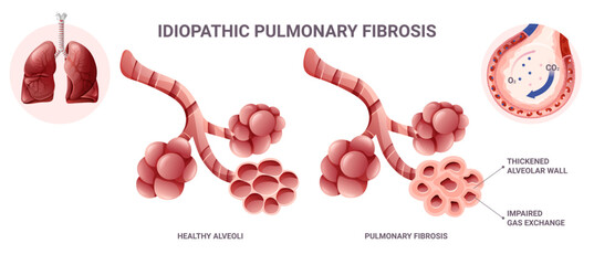 Idiopathic pulmonary fibrosis infographic. Vector illustration isolated on white background - obrazy, fototapety, plakaty