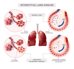 Healthy and pulmonary fibrosis alveoli. Vector illustration isolated on white background