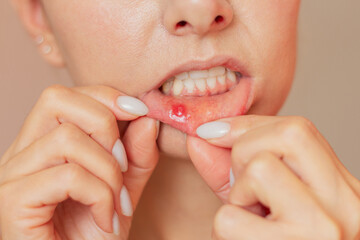 a close-up of the face of a young woman who twists her lower lip with two fingers shows an ulcer of...