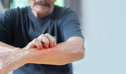 Cropped image of Asian elder man scratching his forearm. Concept of itchy skin diseases such as scabies, fungal infection. - obrazy, fototapety, plakaty