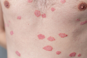 Psoriasis Vulgaris, skin patches are typically red, itchy, and scaly. Papules of chronic psoriasis...