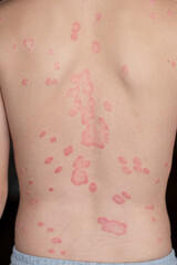 Psoriasis Vulgaris, skin patches are typically red, itchy, and scaly. Papules of chronic psoriasis...