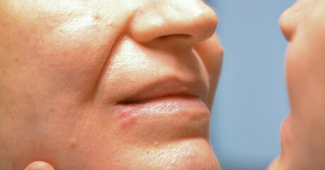 A close-up shot of the face of a 50+ woman looking at herpes on her lip and her facial skin in the...
