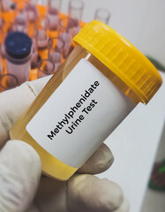Urine sample for Methylphenidate or Retalin test. Stimulant used for attention deficit...