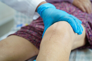 Doctor checking Asian elderly woman patient with scar knee replacement surgery in hospital.