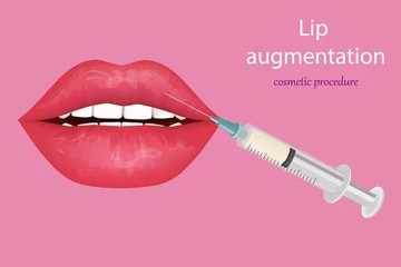 Fotobehang Procedure lip augmentation. Cosmetic procedure that modifies the shape of the lips using fillers. Beauty Injection For Lips. Collagen or implants. © sakurra