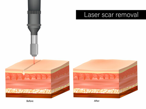 Laser scar removal. Before and After. Laser Scar Reduction. Scar Treatment