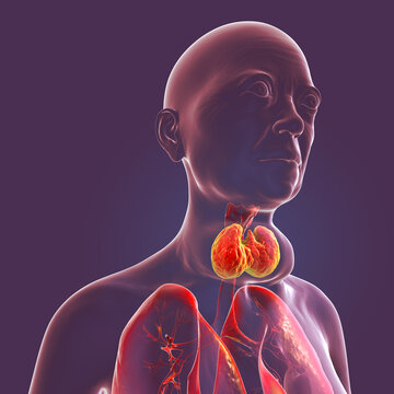 Enlarged thyroid gland, 3D illustration