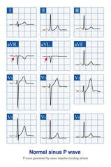 Under normal circumstances, the sinus P wave is the first ECG wave, as the sinus node is very small and the electrical activity generated cannot be recorded by the ECG machine.