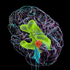 A brain tumor causing hydrocephalus, 3D illustration