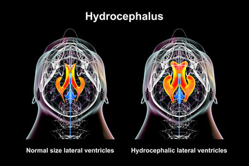 Enlarged and normal lateral ventricles, 3D illustration - obrazy, fototapety, plakaty