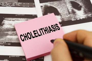 On the ultrasound pictures there are stickers that say - Cholelithiasis