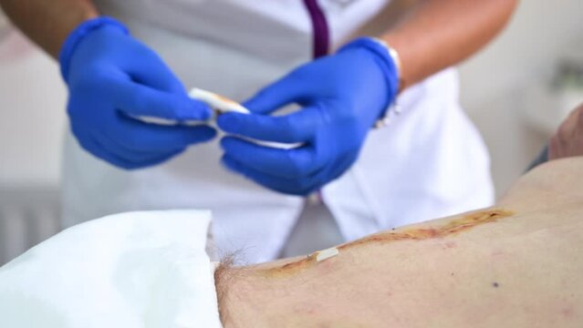 Close up of nurse's hand cleans and treats abdomen injury after surgery at the hospital. Surgical wound on the abdomen. High quality 4k footage
