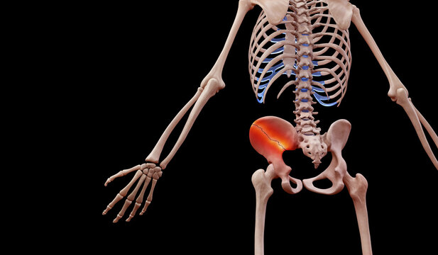 3d rendered illustration of a human skeleton suffering a pelvic hip fracture
