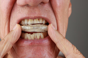 Older Mature Man putting in a night Guard in his mouth to prevent grinding