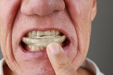 Older Mature Man putting in a night Guard in his mouth to prevent grinding