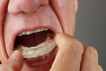 Older Mature Man putting in a night Guard in his mouth to prevent grinding - obrazy, fototapety, plakaty