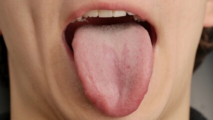 A man shows his tongue. Male tongue sticking out of his mouth. Treatment of ENT diseases. Macro...