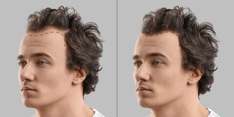 Young man before and after hair loss treatment on grey background