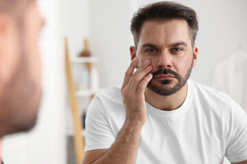 Confused man with skin problem looking at mirror indoors