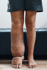Portrait of legs with filariasis or lymphatic filariasis. Patient who suffers from Edema. - obrazy, fototapety, plakaty