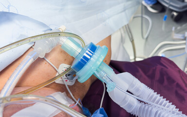 Medical equipment for anesthesia and ventilation in hospitals: endotracheal tubes, mask, oral...