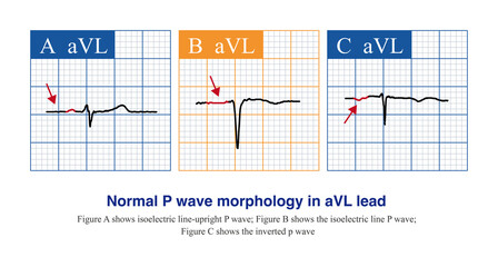 For aVL leads, the morphology of normal P wave is changeable, including upright, isoelectric line-upright, complete  isoelectric line P wave, negative-positive biphasic P wave and inverted P wave.