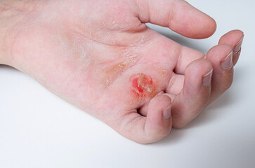 A teenager's palm with a bloody callus from a workout on gymnastics horizontal bar. Athlete hand...