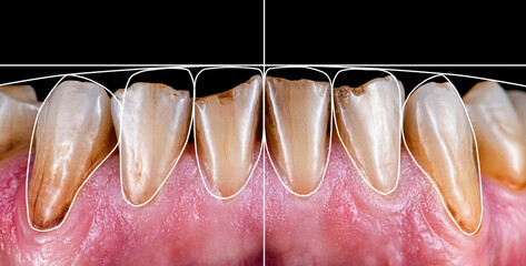teeth digital modeling before starting dental treatment