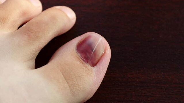 Runner's toe or subungual hematoma after toenail trauma. Bruise under the nail of unhealthy big toe