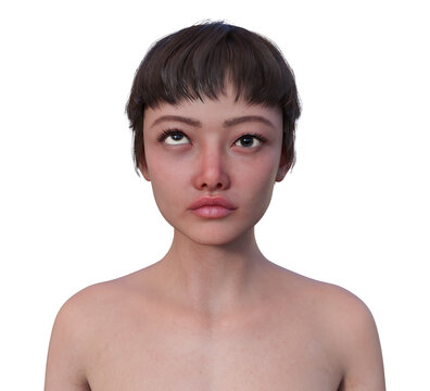 A woman with hypertropia, 3D illustration
