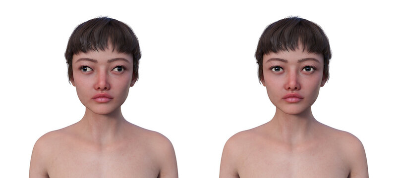 A woman with exotropia and a healthy person, 3D illustration
