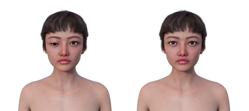 A woman with hypotropia and a healthy person, 3D illustration