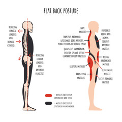 Posture disorders infographics. Flat back posture. The side view shows characteristic decrease natural curves of spine, pelvis rotation, stretched and weakened, shortened and tens muscles. Vector.