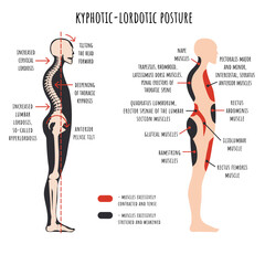 Posture disorders infographic. Kyphotic lordotic posture. The side view shows deformation of rounded shoulders and hyperlordosis, pelvis rotation, stretched and weakened, shortened and tens muscles.