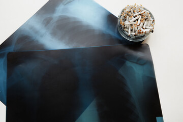Chest X-rays lie on a white table next to an ashtray full of cigarette butts. The dangers of smoking, lung diseases caused by smoking, lung cancer; emphysema; chronic obstructive pulmonary disease