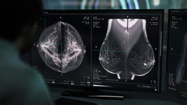 Cancer Detection Technology Analyzing Woman Breast For Diagnosis. Cancer Disease Detection. Medical Technology. Cancer Detection By Modern Healthcare Technology. Mammography. Animation. Scanner