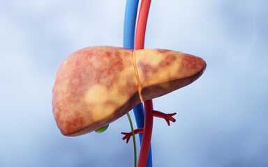 Liver organ with fatty liver state, 3d rendering. - obrazy, fototapety, plakaty