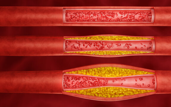 Set of Hyperlipidemia or arteriosclerosis. Blocked artery concept and human blood vessel as a disease with cholesterol fat buildup clogging. Clogged arteries, Cholesterol plaque in the artery