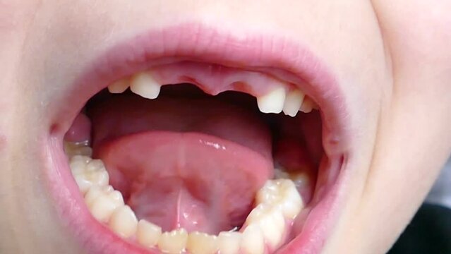 A child's front two primary teeth have fallen out at the age of losing primary teeth,