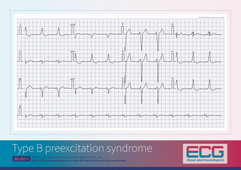 Male, 39 years old, presented with paroxysmal palpitations for 5 years. ECG has typical features of a short PR interval and ventricular preexcitation.