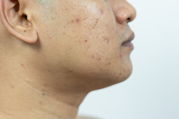 skin problems. problem of inflamed acne on the face. Inflamed acne consists of swelling, redness,...
