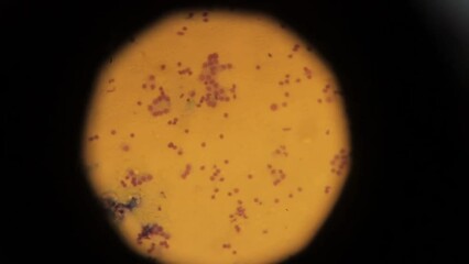 biopsy. biopsy results under a microscope. Human cancer cells under a microscope. human cells taken as a result of a biopsy for study in a laboratory using professional equipment. Anatomical theme.