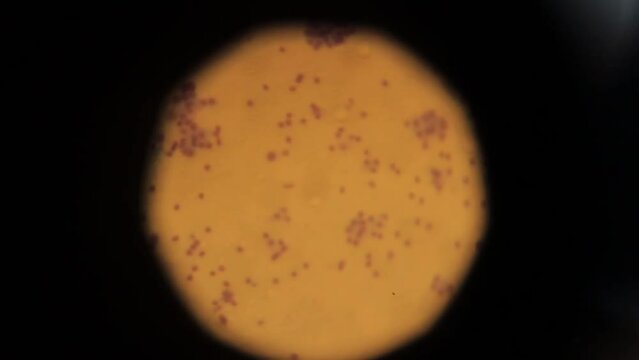biopsy. biopsy results under a microscope. Human cancer cells under a microscope. human cells taken as a result of a biopsy for study in a laboratory using professional equipment. Anatomical theme.