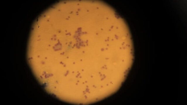 biopsy. biopsy results under a microscope. Human cancer cells under a microscope. human cells taken as a result of a biopsy for study in a laboratory using professional equipment. Anatomical theme.